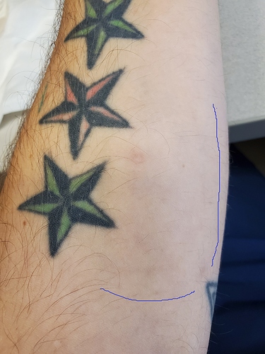 arm
