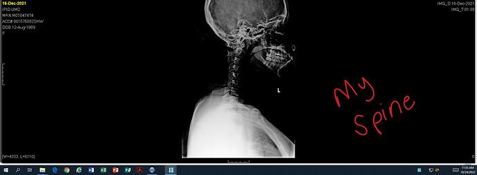 Old spine xray .PNG