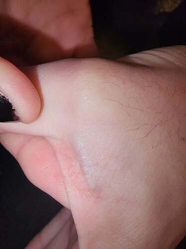 implant