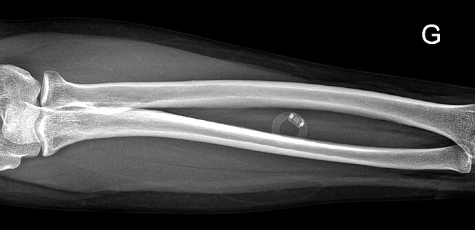 xray_4