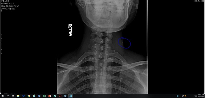 ZA Xray14.PNG