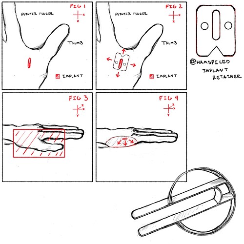 ImplantCrimp