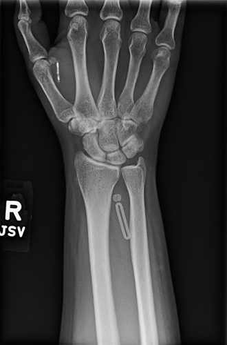 WRIST BILATERAL 2 VIEW - Set 1 - Image 1